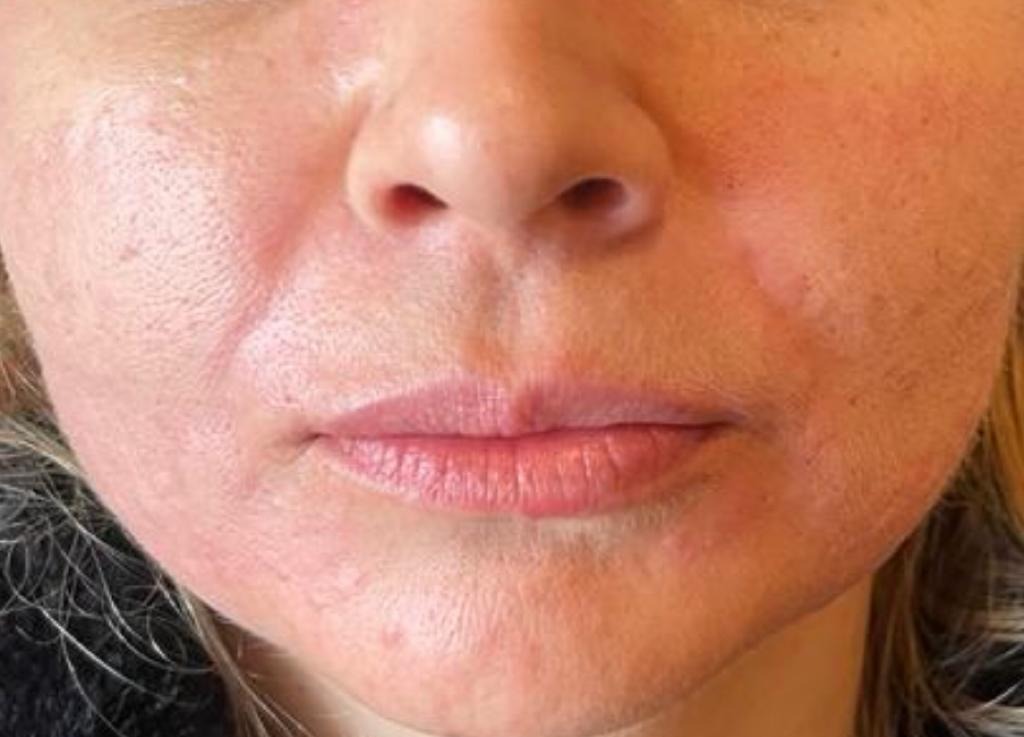 Nasolabial Filler After