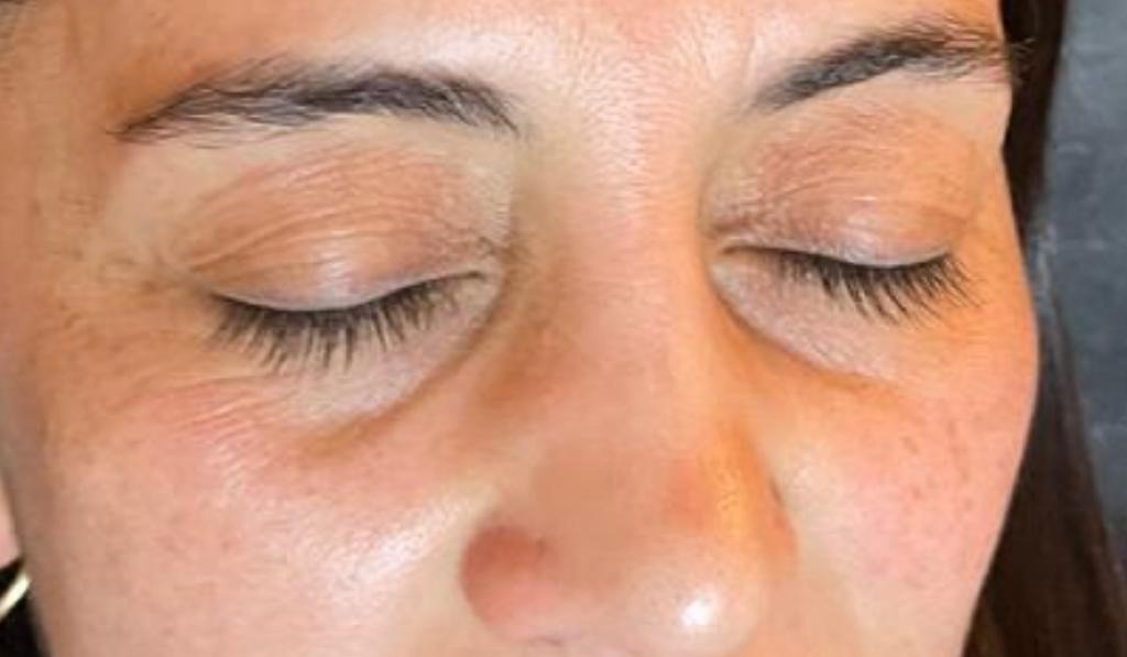 Under Eye Filler Before