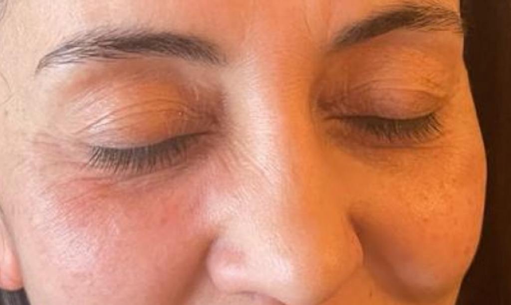 Under Eye Filler After