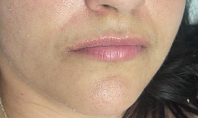 Lip Filler Before