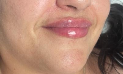 Lip Filler After