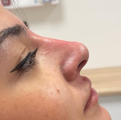 Nose Filler After