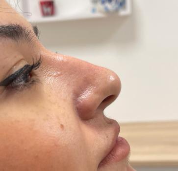 Nose Filler Before