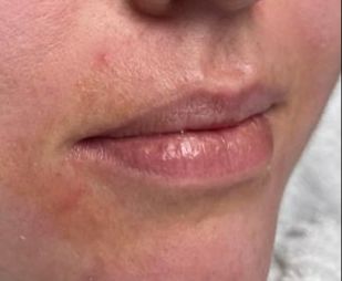 Lip Filler Before