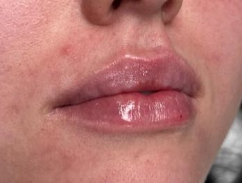 Lip Filler After